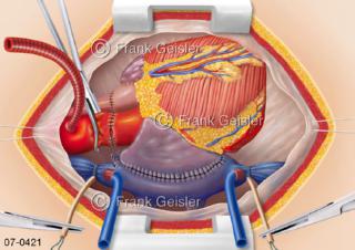 Herztransplantation, Transplantation Herz, OP Phase 3