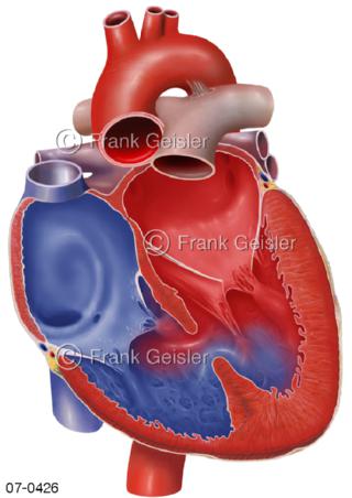 Herz, Herzfehler Ventrikelseptumdefekt VSD