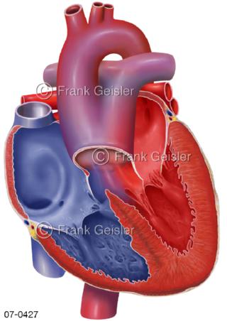 Herz, Herzfehler Truncus arteriosus communis TAC