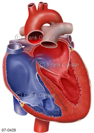 Herz mit Herzfehler Ebstein-Anomalie