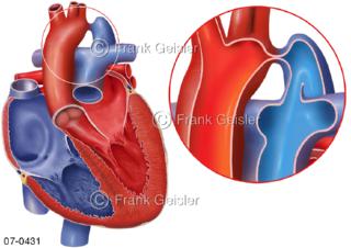 Herzfehler Stenose, Praeduktale Aortenisthmusstenose