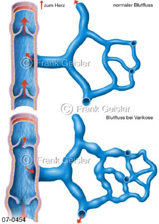 Krampfadern, Blutfluss Venen und Varikose