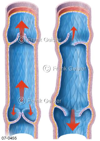 Blutfluss in Venen und Blutstau