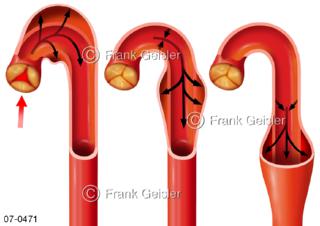 Schlagader Aorta mit Windkesselfunktion zum Druckausgleich im Herz-Kreislauf-System