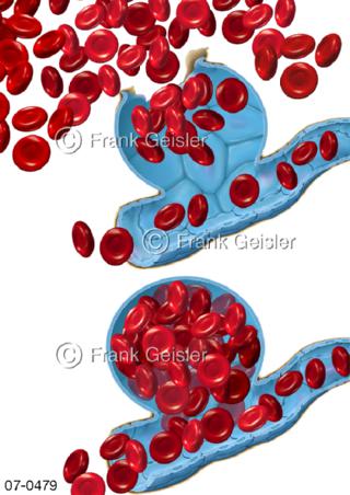 Arterie Arterienerweiterung Aneurysma