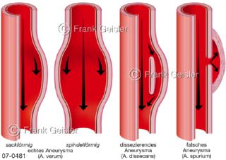 Arterien mit Aneurysma, Blutfluss bei Aneurysmen