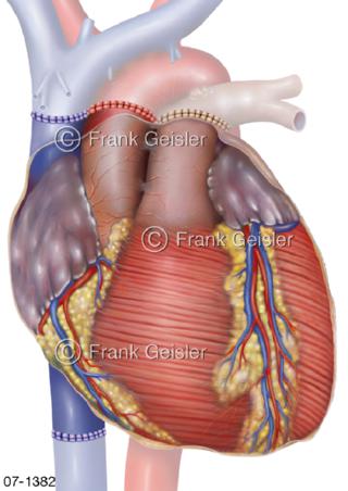 Herztransplantation bicavale Anastomosen
