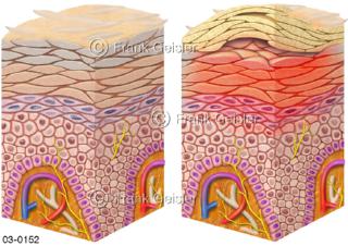 Haut mit Neurodermitis, atopisches Ekzem der Epidermis