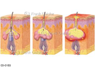 Haut mit Akne, Verhornung von Talg und Entzündung der Talgdrüsen