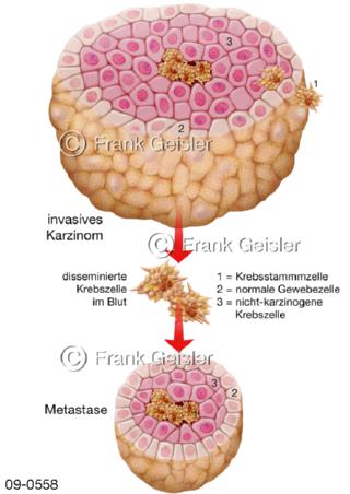 Tumor, Metastasen durch Krebszellen