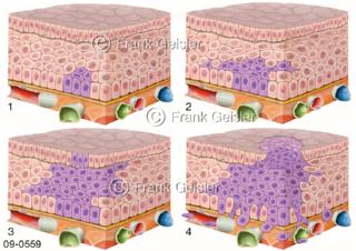Krebs, Mehrschritt-Karzinogenese, vielschichtige Prozess der Krebsentstehung