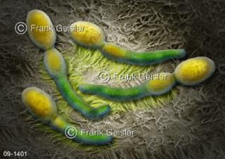 Kandidose, Erreger Hefepilze Candida albicans verursacht Infektion der Schleimhaut