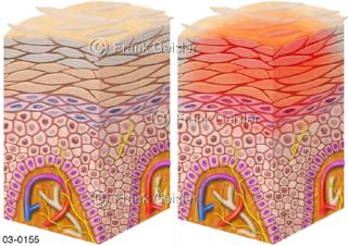 Epidermis der Haut, Entzündung der Oberhaut