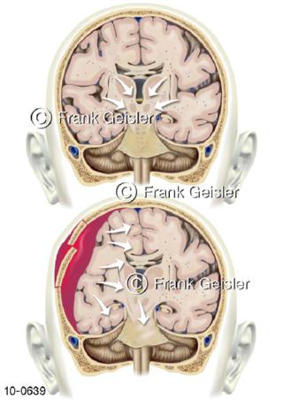 Hirndruck bei Schädelbruch Hirnblutung