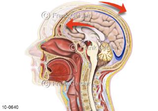 Starke Kopfbewegung, Schädel-Hirn-Trauma SHT Gehirnerschütterung
