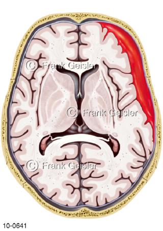 Schädel mit Subduralhämatom, subdurales Hämatom