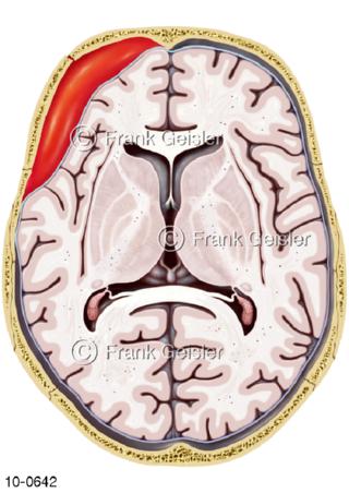 Schädel mit Epiduralhämatom epidurales Hämatom