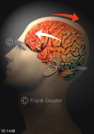 Kopf Gehirn mit Gehirnerschütterung