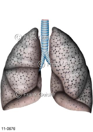 Luftröhre Trachea mit Lungen einer Raucherlunge