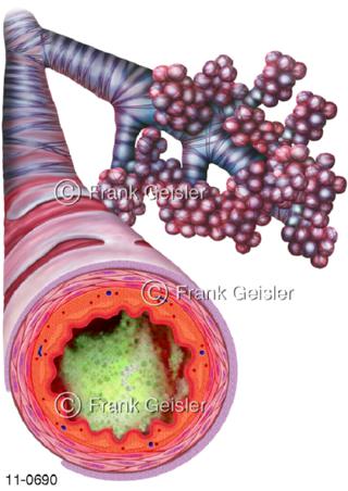  Atemwege, Lumen Bronchien bei Bronchitis