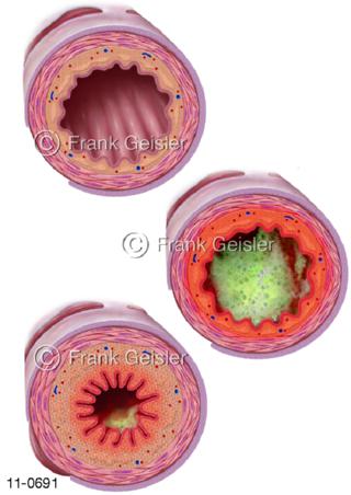 Bronchien, Bronchus mit Bronchitis und Asthma