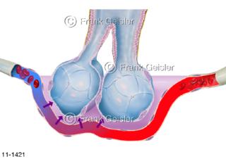 Ödem Lunge, intestielles Lungenödem, Flüssigkeitsansammlung in Wasserlunge