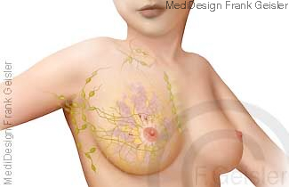 Lymphgefäße und Lymphknoten der weiblichen Brust Lymphgefäße und Lymphknoten der weiblichen Brust