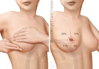Brustkrebs-Vorsorge, Lokalisation Mammakarzinom 