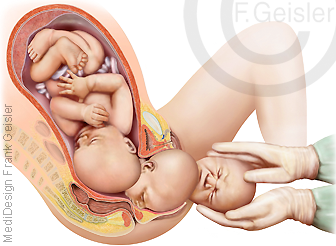 Geburt, Geburtsvorgang durch Geburtskanal 