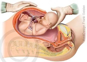 Schnittentbindung, Kaiserschnitt Sectio caesarea